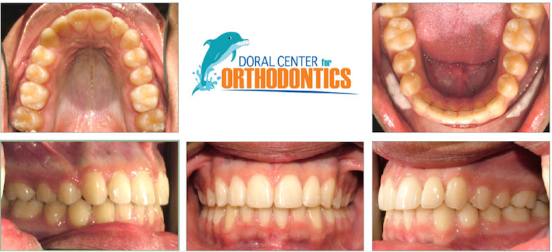 Orthodontics Before And After Pictures in Miami & Doral, FL