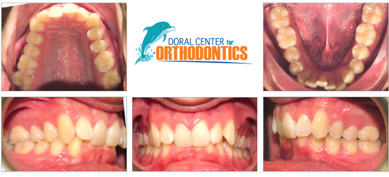 Orthodontics Before And After Pictures in Miami & Doral, FL