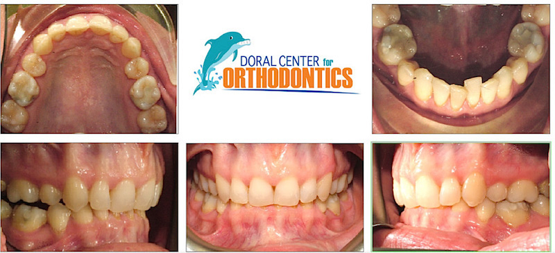 Orthodontics Before And After Pictures in Miami & Doral, FL