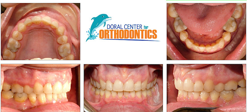 Orthodontics Before And After Pictures in Miami & Doral, FL