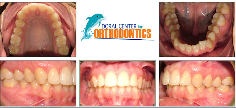 Orthodontics Before And After Pictures in Miami & Doral, FL