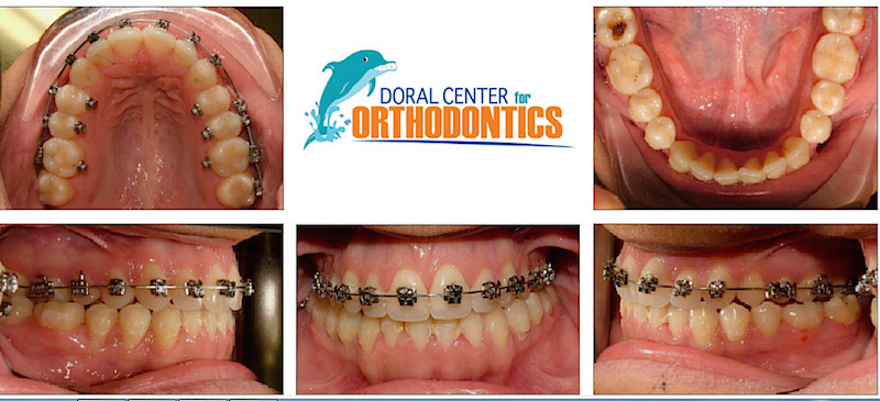 Orthodontics Before And After Pictures in Miami & Doral, FL