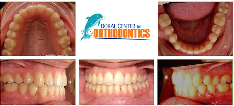 Orthodontics Before And After Pictures in Miami & Doral, FL