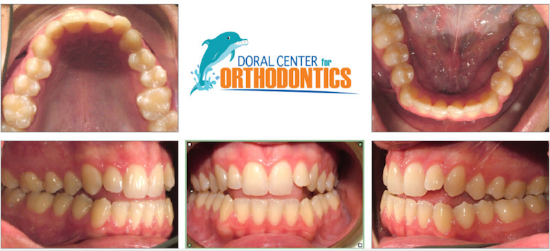 Orthodontics Before And After Pictures in Miami & Doral, FL