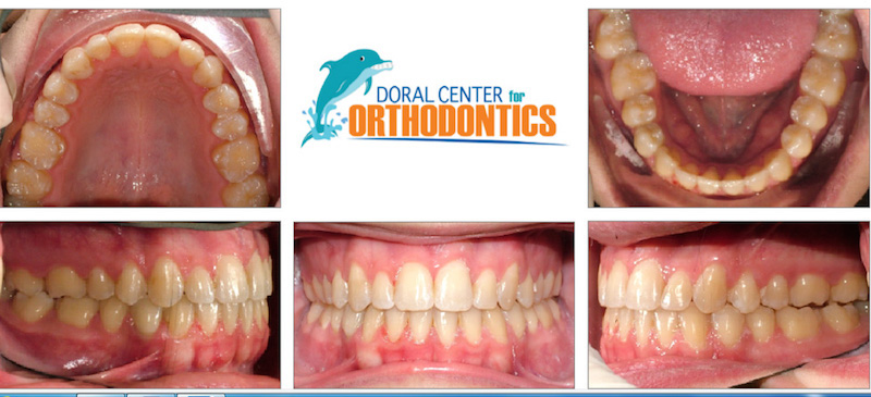 Orthodontics Before And After Pictures in Miami & Doral, FL