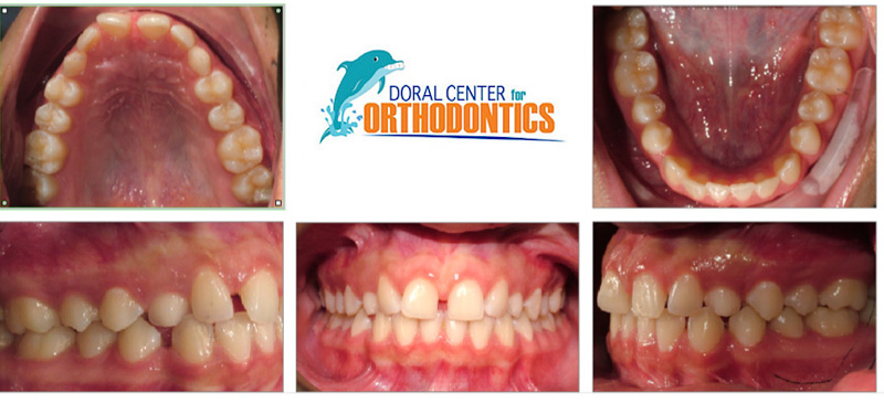 Orthodontics Before And After Pictures in Miami & Doral, FL