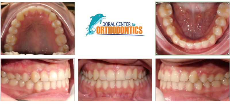 Orthodontics Before And After Pictures in Miami & Doral, FL