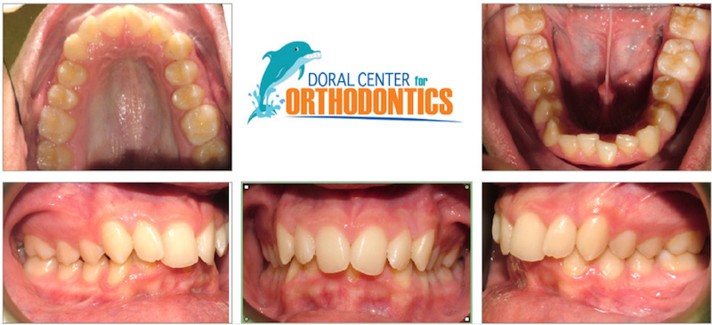 Orthodontics Before And After Pictures in Miami & Doral, FL