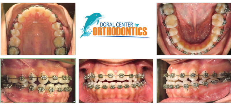 Orthodontics Before And After Pictures in Miami & Doral, FL