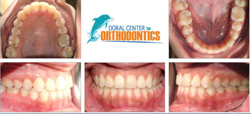 Orthodontics Before And After Pictures in Miami & Doral, FL