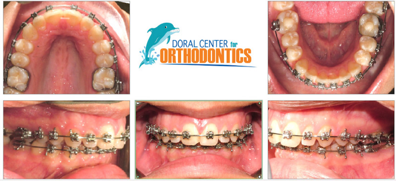 Orthodontics Before And After Pictures in Miami & Doral, FL