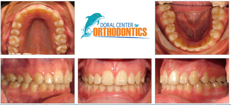 Orthodontics Before And After Pictures in Miami & Doral, FL