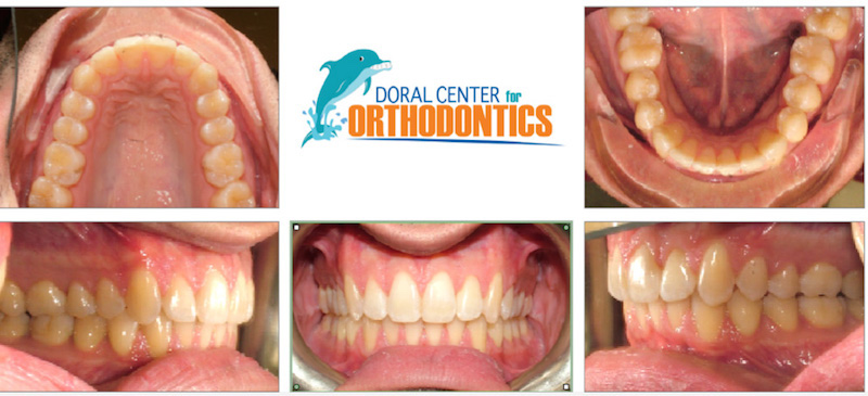 Orthodontics Before And After Pictures in Miami & Doral, FL