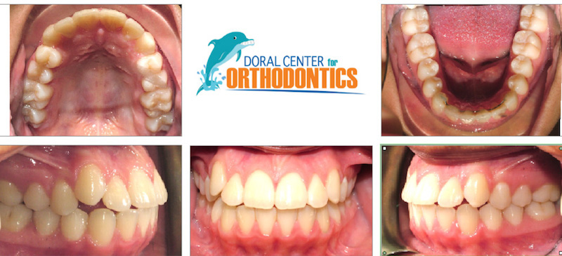 Orthodontics Before And After Pictures in Miami & Doral, FL