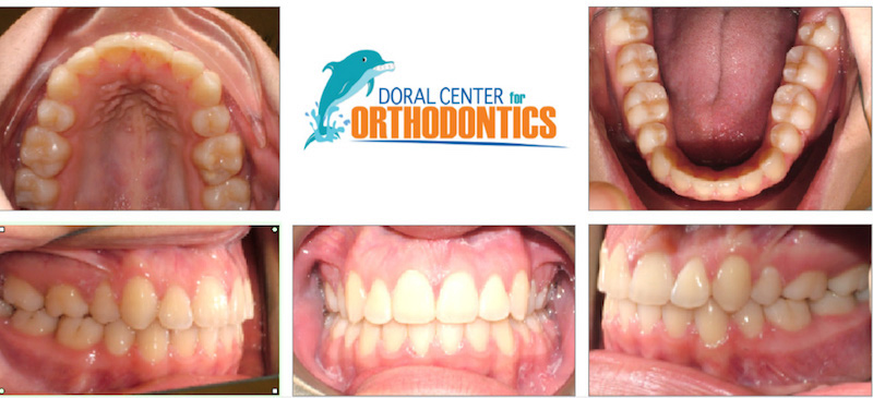 Orthodontics Before And After Pictures in Miami & Doral, FL