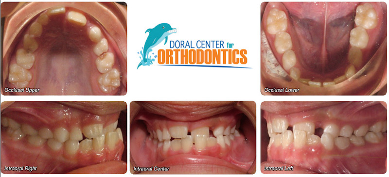 Orthodontics Before And After Pictures in Miami & Doral, FL