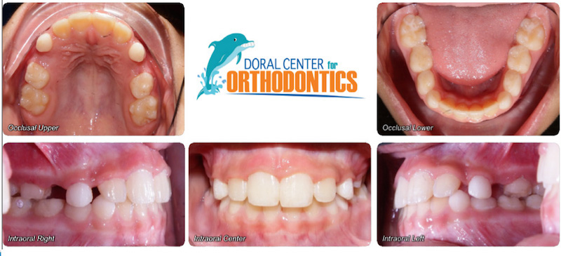 Orthodontics Before And After Pictures in Miami & Doral, FL