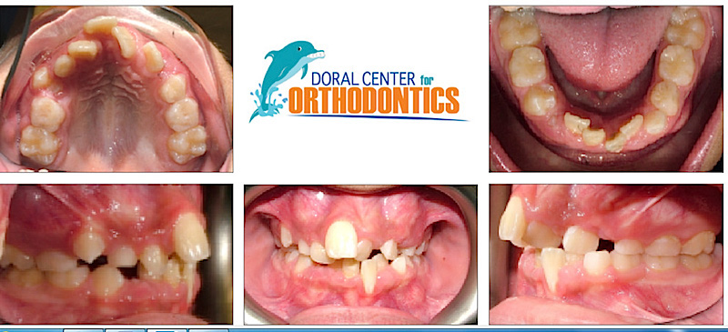 Orthodontics Before And After Pictures in Miami & Doral, FL