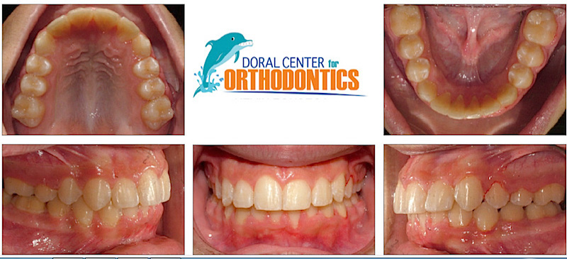 Orthodontics Before And After Pictures in Miami & Doral, FL