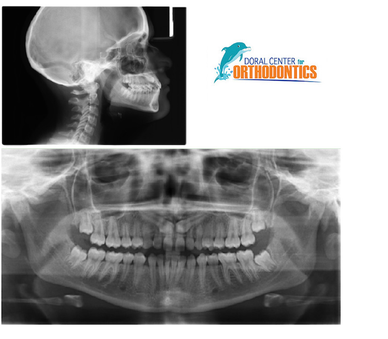 Orthodontics Before And After Pictures in Miami & Doral, FL